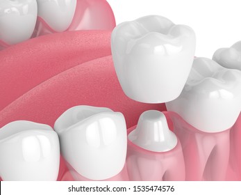 3D-Rendering des Kiefers mit Zähnen und Wiederherstellung der Zahnkronen auf weißem Hintergrund