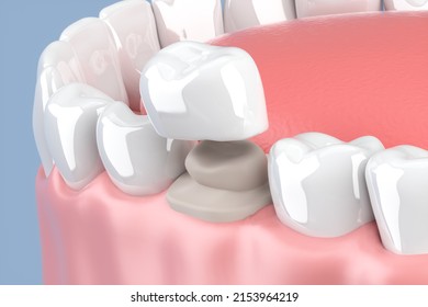 3d Render Of Jaw With Teeth And Dental Crown Restoration. 3D Illustration