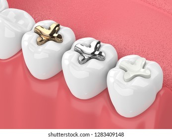 3d Render Of Jaw With Teeth And Three Types Of Inlay Over White