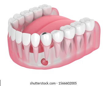 3d Render Of Jaw With Tooth Cavity And Cyst. Dental Problem Concept.