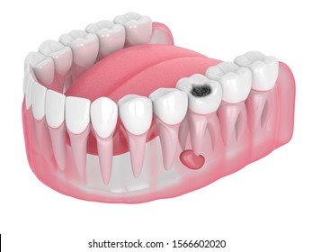 3d Render Of Jaw With Tooth Cavity And Cyst. Dental Problem Concept.