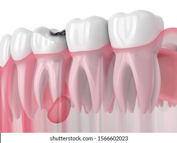 3d Render Of Jaw With Tooth Cavity And Cyst. Dental Problem Concept.