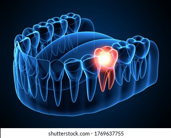 3D-Renderung der Kieferröntgen mit schmerzhaftem Zahn. Zahnschmerzkonzept. 