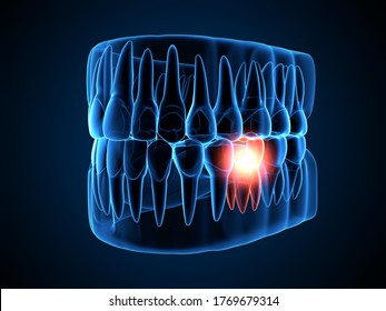 3d render of  jaw x-ray with aching molar tooth. Toothache concept. 
