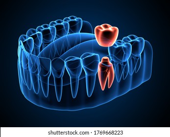 3D-Rendering der KieferRöntgenaufnahme mit einer auf dem umgestalteten Zahn eingelegten Zahnkrone 