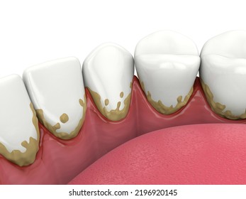 3d Render Of Lower Jaw With Calculus Buildup On Teeth Line And Making Inflammation