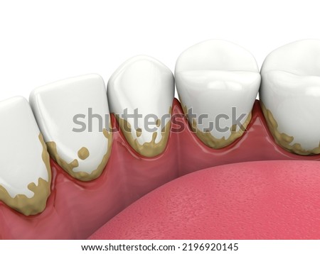 3d render of lower jaw with calculus buildup on teeth line and making inflammation