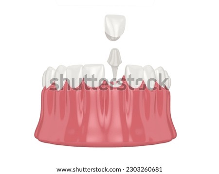 3d render of lower jaw with post and core tooth restoration over white background