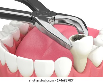 3d Kieferrenderung mit Zahn, der durch zahnärztliche Zähne extrahiert wird