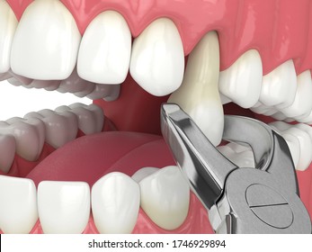 3d Kieferrenderung mit Zahn, der durch zahnärztliche Zähne extrahiert wird
