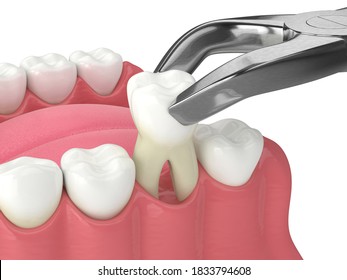 3D-Renderung des Unterkiefers mit Zahn-Zahn