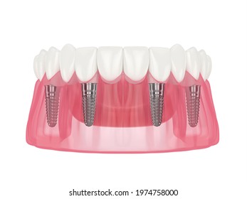 3d Render Of Mandibular Prosthesis All On 4 System Supported By Over White Background