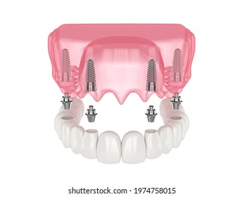 3d Render Of Mandibular Prosthesis All On 4 System Supported By Over White Background