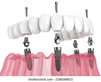 3d Render Of  Mandibular Prosthesis All On 4 System Supported By Implants Over White Background