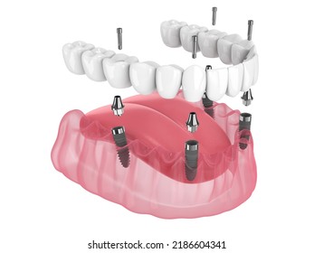 3d Render Of Mandibular Prosthesis All On 4 System Supported By Implants Over White Background