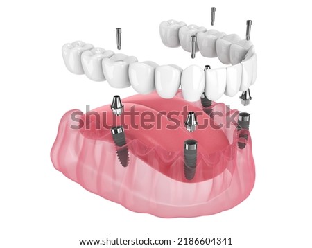 3d render of mandibular prosthesis all on 4 system supported by implants over white background Foto d'archivio © 