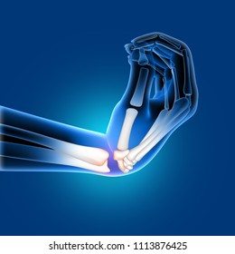 3D Render Of A Medical Image Of A Painful Bent Wrist