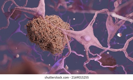 3D Render Of Neurons With Amyloid Plaque. Relevant To Brain Disease Such As Alzheimer's Disease.
