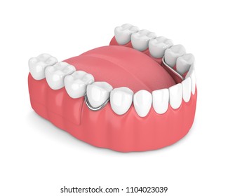 3d render of removable partial denture isolated over white background