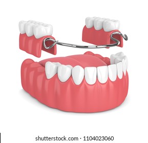 3d render of removable partial denture isolated over white background