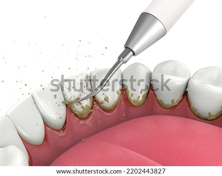 3d render of removing tartar and plaque from teeth by ultrasonic scaler. Dental descaling concept