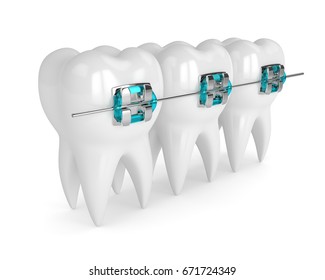 3d render of teeth with braces isolated over white background