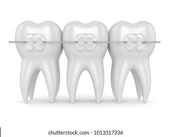 3d Render Of Teeth With Ceramic Clear Braces Isolated Over White Background