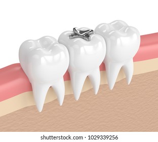 3d Render Of Teeth With Dental Amalgam Filling In Gums