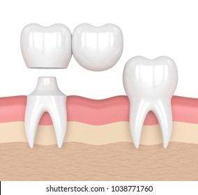 3d Render Of Teeth With Dental Cantilever Bridge In Gums