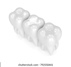 3d Render Of Teeth With Dental Composite Filling Over White Background