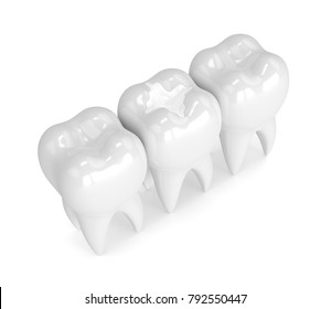 3d render of teeth with dental composite filling over white background