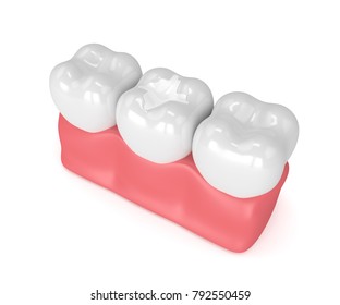 3d render of teeth with dental composite filling in gums over white background