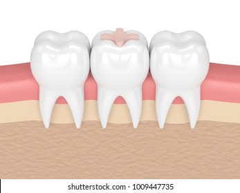 Incrustacion Dental Imagenes Fotos De Stock Y Vectores Shutterstock