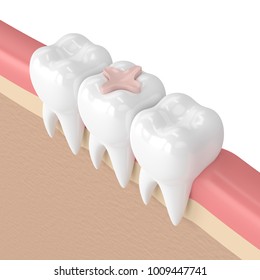 3d Render Of Teeth With Dental Inlay Filling In Gums