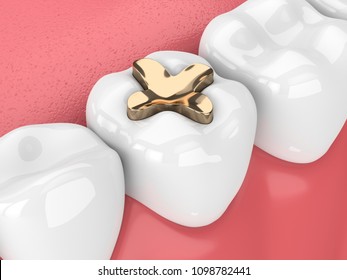 3d Render Of Teeth With Dental Inlay Golden Filling Over White Background