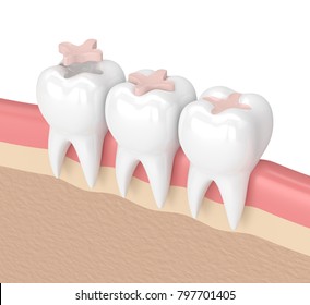 3d Render Of Teeth With Dental Inlay Filling In Gums