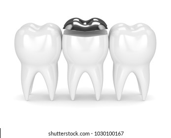 3d Render Of Teeth With Dental Onlay Amalgam Filling Over White Background