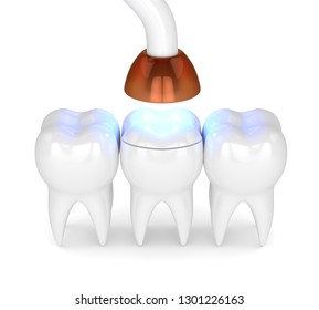 light cure teeth