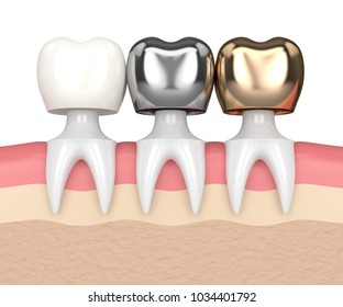 3d Render Of Teeth With Gold, Amalgam And Composite Dental Crown In Gums