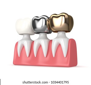 3d Render Of Teeth With Gold, Amalgam And Composite Dental Crown In Gums Over White Background