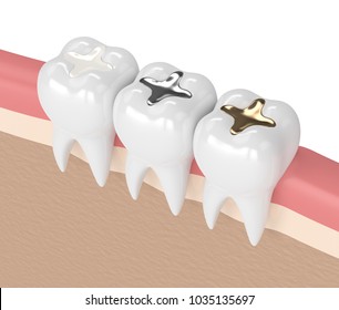 3d render of teeth with gold, amalgam and composite inlay dental filling in gums