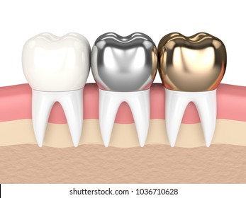 3d Render Of Teeth With Gold, Amalgam And Composite Dental Crown In Gums