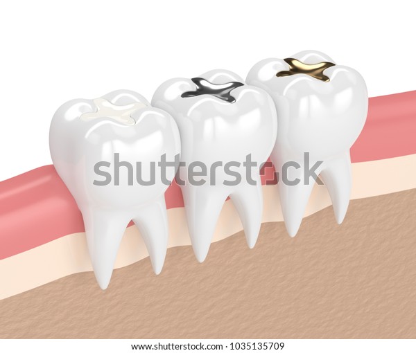 3d render of teeth with gold, amalgam and\
composite inlay dental filling in\
gums