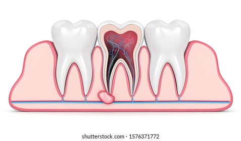 3d Render Of Teeth In Gums With Cyst. Dental Problem Concept.