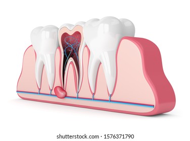 3d Render Of Teeth In Gums With Cyst. Dental Problem Concept.