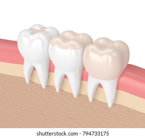 3d Render Of Teeth With Inlay, Onlay And Crown Filling In Gums