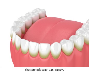 3d Render Of Teeth With Plaque And Tartar Over White Background