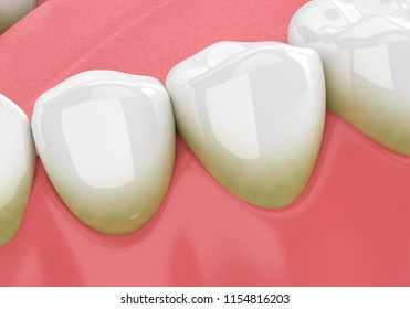 3d Render Of Teeth With Plaque And Tartar Over White Background