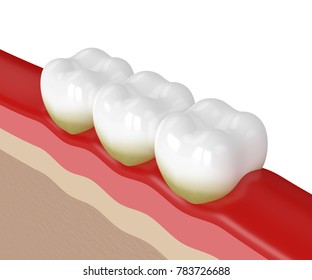 3d Render Of Teeth With Plaque And Tartar Over White Background