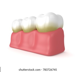 3d Render Of Teeth With Plaque And Tartar Over White Background